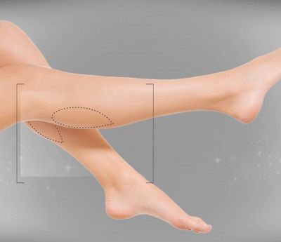 фото не тему: Пластика голеней – операция для тех, кто комплексует по поводу формы ног