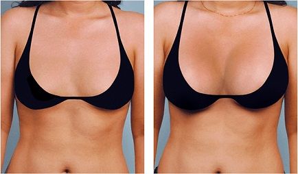 Пластика груди: фото до и после