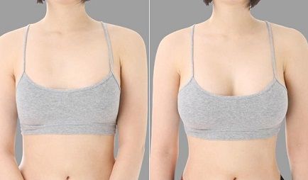 Пластика груди: фото до и после