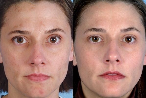 Аппаратная косметология: фото до и после