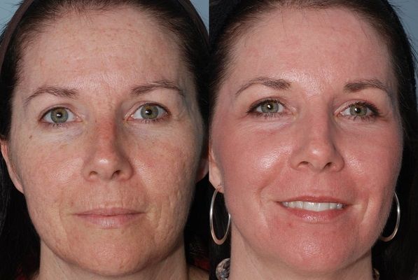 Аппаратная косметология: фото до и после