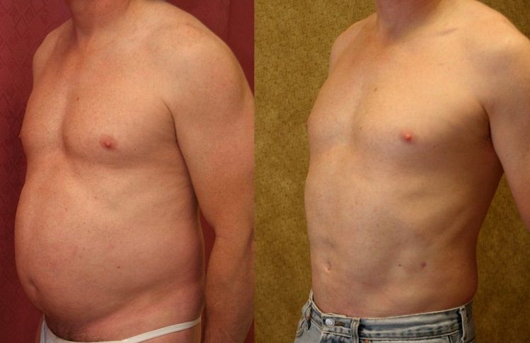 Липосакция у мужчин: фото до и после