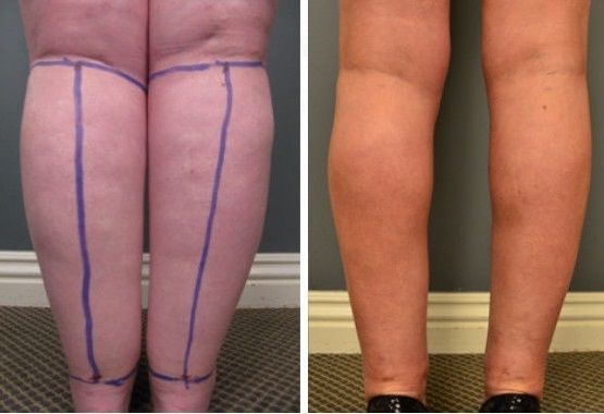 Липосакция ног: фото до и после