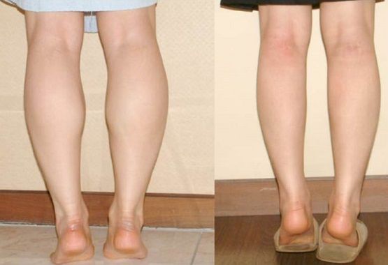 Липосакция ног: фото до и после